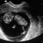 Ultrasonda 10 haftalık hamilelik