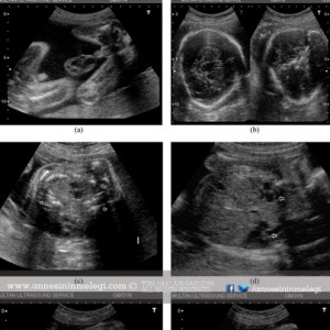 hafta hafta hamilelik 38 hafta hamilelik ultrason görüntüsü hafta hafta gebelik