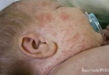 Bebeğim isilik oldu, ne yapmalıyım?