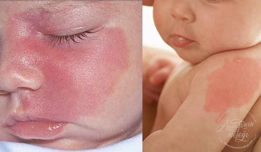 Doğum lekesi, çilek lekesi mi hemanjiyoma mı Hemanjiyoma ya da çilek lekesi adı verilen kırmızı, düz lekeler, yeni doğanların yüzde 2,5'una kadar bebek cildinde en sık görülen oluşumlardır. Yenidoğan bebekler doğduklarında göz kapaklarının üzerinde , alınlarının ortasında, bazen burunlarının altında kızarıklık şeklinde doğum lekeleri olabilir dogum lekesi  dogum lekesi nedir doğum lekeleri nasıl olur doğum lekesi neden olur bebeklerde doğum lekeleri neden olur  doğum lekesi nedir doğum lekesi neden oluşur  doğum izi neden olur doğum lekesi sebepleri doğum lekesi neden çıkar vücuttaki doğum lekeleri nasıl geçer doğum lekeleri neden oluşur hamilelikte doğum lekesi nasıl oluşur doğum lekeleri nasıl oluşur gözde doğum lekesi bebekte doğum lekesi neden olur dogum lekeleri geçer mi bebek doğum lekeleri bacakta doğum lekesi doğum lekesi nasıl olur bebeklerde gül lekesi neden olur doğum lekesi nasıl oluşur doğum izi bebeklerde doğum lekesi  bebekte gül lekesi neden olur bebeklerde leke neden olur kırmızı doğum lekesi tedavisi bebeğin yüzünde doğum lekesi doğum lekeleri ne anlama gelir gül lekesi yeni doğan bebekte kırmızı lekeler bebeklerde doğum lekeleri nasıl geçer  doğum lekesi anlamları bebeklerdeki doğum lekeleri nasıl geçer bebeklerde gül lekesi geçer mi bebeklerde lekeler beyaz doğum lekesi annede doğum lekesi neden olur bebek doğum lekesi nasıl geçer dinimizde doğum lekesi bebekte leke salmon lekesi bebeklerde gül lekesi bebeklerde somon lekesi doğum izi nasıl geçer yeni doğan bebeklerde doğum lekesi  doğum lekesi ne zaman geçer dogum lekesi anlamı bebeklerde cilt lekesi yüzde doğum lekesi doğum lekelerini ne geçirir yeni doğan bebeklerin yüzündeki kırmızı lekeler bebeklerde gül doğum lekeleri ne zaman geçer doğum lekeleri için bebeklerde çilek lekesi salmon lekeleri doğum lekesi çeşitleri doğum lekesi nasıl çıkar bebeklerde dogum lekesi ne zaman gecer bebeklerde cilt lekeleri doğum lekesi sildirme hamilelik lekeleri için maskeler hamilelikte doğum lekesi doğum lekesi neden olur islami doğum lekeleri nasıl geçer  yüzdeki doğum lekeleri nasıl geçer kahverengi doğum lekeleri  bebeklerde kırmızı lekeler  doğum lekeleri için krem doğum lekesi tedavisi gül lekesi hastalığı yeni doğan bebeğin alnındaki kızarıklık bebeğin yuzunde kirmizi lekeler bebek yuzunde kirmizi leke  yüzdeki doğum lekelerine bitkisel çözüm demet akalın volkan demirel bebeklerde sonradan çıkan kahverengi lekeler volkan demirel kızı kahverengi doğum lekesi tedavisi bebeklerin yüzlerinde kızarıklık bebeklerin yüzündeki kırmızı lekeler nasıl geçer bebek vücudunda kahverengi lekeler neyin belirtisi bebeklerde yüzünde kızarıklık yüzdeki mor lekeler yüzde mor lekeler hamilelik lekelerine çözüm bebeklerde gül hastalığı doğum izleri nasıl geçer bebeklerde kahverengi lekeler vücut lekesi yeni doğan bebeğin vücudunda kırmızı noktalar yeni doğan bebekte kırmızı sivilceler bebeklerde kahverengi lekeler neden olur bebekte leke yapan yiyecekler doğum lekesi kitap yüzdeki sarı lekeler boyun bölgesinde lekeler göz kapağında kırmızı leke burunda leke doğum lekesi doğum lekesi tedavisi izmir doğum lekesi lazer doğum lekesi dövme doğum lekesi lazer tedavisi dogum lekesi geçer mi doğum lekesi büyür mü doğum lekesi nasıl giderilir doğum lekesi ekşi doğum lekesi islami doğum lekesi için kremler doğum lekesi neden doğum lekesi ameliyatı doğum lekesi astsubaylık doğum lekesi annede dogum lekesi anlamı doğum lekesi aldırma fiyatları doğum lekesi ameliyatı izle doğum lekesi aldırma ameliyatı doğum lekesi askerlik doğum lekesi aldırmak günah mı doğum lekesi askeri lise doğum lekesi a doğum lekesi ben doğum lekesi batıl inançlar doğum lekesi bitkisel çözüm doğum lekesi beyaz olur mu doğum lekesi ben aldırma doğum lekesi büyümesi doğum lekesi benler doğum lekesi bitkisel tedavisi doğum lekesi beyaz doğum lekesi ciğer dogum lekesi cesitleri dogum lekesi cilek doğum lekesi caragh dogum lekesine cozum doğum cilt lekeleri dogum lekesi nasil cikar doğum lekesi plastik cerrahi dogum lekesi sonradan cikar mi dogum lekesi neden cikar doğum lekesi çoğalır mı doğum lekesi çeşitleri doğum lekesi çilek doğum lekesi çıkar mı doğum lekesi çözümü doğum lekesine çözüm doğum lekeleri çeşitleri doğum lekesi nasıl çıkar doğum lekesi neden çıkar doğum lekesi evde çözüm doğum lekesi dövmesi doğum lekesi doğal çözüm doğum lekesi duası doğum lekesine doğal çözümler doğum lekesine doğal çözüm doğum lekeli dansçı doğum lekesi ne demek doğum lekesi hangi doktor dogum lekesi üzerine dövme doğum lekesi epilepsi doğum lekesi estetik doğum lekesi eski hayat doğum lekesi estetiği doğum lekesi et beni doğum lekesi ekşi sözlük doğum lekesine elma sirkesi doğum lekeleri expigment doğum lekesi filmi doğum lekesi forum doğum lekesi fiyatları dogum lekesi fransizca doğum lekeleri fiyatı doğum lekesi tedavisi fiyatları doğum lekesi sildirme fiyatları doğum lekesi tedavi fiyatları doğum lekesi tedavisi forum doğum lekesi tedavisi fiyat doğum lekesi gül doğum lekesi geçirme doğum lekesi giderme doğum lekesi genetik mi doğum lekesi geçmiş yaşam doğum lekesi giderici krem doğum lekesi gelince namaz kılınır mı doğum lekesi göz kapağı doğum lekesi görseller doğum lekesi harp okulu doğum lekesi hikayesi doğum lekesi hemanjiom doğum lekesi hastalıkları doğum lekesi hangi renk olur doğum lekesi herkeste olur mu doğum lekesi hurafeleri doğum lekesi hikayeleri doğum lekesi harita doğum lekesi leylek ısırığı doğum lekesi için doğum lekesi için ilaç doğum lekesi inancı doğum lekesi için maske doğum lekesi ingilizce doğum lekesi için dua doğum lekesi için hangi doktora gidilir doğum lekesi isimleri polislik için doğum lekesi doğum lekesi kanser doğum lekesi krem doğum lekesi kitap doğum lekesi kıllı doğum lekesi kapatıcı doğum lekesi kırmızı doğum lekesi kapatma doğum lekesi kanaması doğum lekesi kadınlar kulübü doğum lekesi kapatıcı krem kadın doğum lekeleri doğum lekesi lr doğum lekesi lazer tedavisi fiyatları doğum lekesi lazer tedavisi yapan hastaneler doğum lekesi latince doğum lekesi lazer tedavisi izmir doğum lekesi için lazer tedavisi kahverengi doğum lekesi lazer tedavisi doğum lekesi maskesi doğum lekesi makyajla nasıl kapatılır doğum lekesi msü doğum lekesi morluk doğum lekesi mutasyon mudur dogum lekesi melek opucugu dogum lekesi maske doğum lekesi mitoloji doğum lekesi manası doğum lekeli manken doğum lekesi nasıl doğum lekesi nedir doğum lekesi nasıl kapatılır doğum lekesi neden kaşınır doğum lekesi nasıl geçiyor doğum lekesi nasıl önlenir doğum lekesi nasıl geçer ibrahim saraçoğlu doğum lekesi ne zaman oluşur doğum lekesi olan polis olabilir mi doğum lekesi olan insanlar doğum lekesi olmaması için ne yapmalı doğum lekesi olan ünlüler doğum lekesi olan bebekler doğum lekesi onedio doğum lekesi neden olur doğum lekesi neden oluşur doğum lekesi nasıl olur doğum lekesi polis olmaya engel mi doğum lekesi önceki hayat doğum lekelerini önlemek için doğum öncesi leke gelmesi doğum öncesi leke doğum lekesi kitap özeti doğum lekeleri nasıl önlenir doğum lekesi peeling doğum lekesi polisliğe engel mi doğum lekesi polislik doğum lekesi polis olmayı engeller mi doğum lekesi pomem doğum lekesi pdf indir doğum lekesi pdf doğum lekesi pmyo doğum lekesi rengi doğum lekesi reenkarnasyon doğum lekesi roman doğum lekeleri reenkarnasyon doğum lekesi ne renk olur doğum lekesi çeşitleri resimli doğum lekesi açık renk doğum lekeleri ve reenkarnasyon rüyada doğum lekesi görmek lr doğum lekesi lr doğum lekesi için doğum lekesi sildirme doğum lekesi silinir mi doğum lekesi subay olmaya engel mi doğum lekesi serisi doğum lekesi sebebi doğum lekesi siyah doğum lekesi sebepleri doğum lekesi sonradan oluşur mu doğum lekesi silme izmir doğum lekesinin şişmesi doğum lekeleri şems aslan doğum şarap lekesi doğum lekesi kalp şeklinde gönlümün doğum lekesi şarkı sözü doğum lekeleri şarap lekesi doğum lekesi tedavisi doğum lekesi türleri doğum lekesi tehlikelimi doğum lekesi tedavisi ankara doğum lekesi tedavisi yapan hastaneler doğum lekesi tedavisi bursa doğum lekesi tedavisi bitkisel doğum lekesi tedavisi yapan hastaneler istanbul doğum lekesi uzman çavuş doğum lekesi uzman tv dogum lekeli unluler bebeklerde doğum lekesi uzman tv doğum lekesi neden olur uzman tv ultrasonda doğum lekesi belli olurmu doğum lekesi üzerine dövme doğum lekesi üzerine dövme yapılır mı doğum lekesinin üstüne dövme doğum lekesi ve güneş doğum lekesi ve anlamları doğum lekesi vitiligo doğum lekesi vikipedi doğum lekesi vine doğum lekesi ve tedavisi doğum lekesi var midir dogum lekesi var mı doğum lekeleri ve anlamları doğum lekesi yüzde doğum lekesi yok etme doğum lekesi yapan yiyecekler doğum lekesi yorum dogum lekesi yayılır mı doğum lekesi yüzünden çocuğunu içine şeytan girdi diye yakmaya çalıştı doğum lekelerini yok etme dogum lekeleri yuzde çilek doğum lekesi yapar mı i doğum lekesi doğum lekesi zararlımı doğum lekesi zararlı mıdır doğum lekesi zararları doğum lekesinin zararları dogum lekeleri zararlımı doğum lekesi ne zaman kaybolur dogum lekesi ne zaman olur doğum lekesi ne zaman geçer doğum lekesi ne zaman çıkar dogum lekesi ne zaman belli olur 2 tane doğum lekesi doğum lekesi 2 doğum lekesi serisi 3. kitap