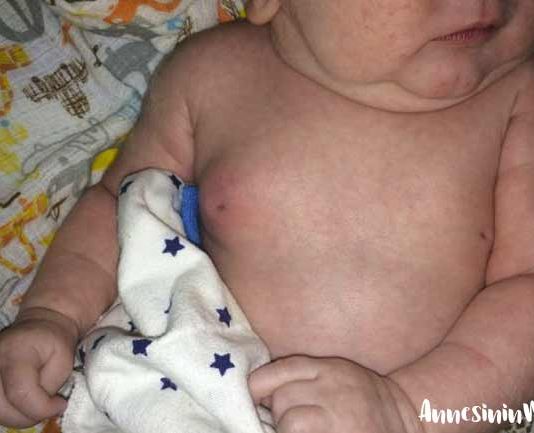 Yeni doğan bebekte memede şişlik ve yenidoğan mastiti Yenidoğan mastiti