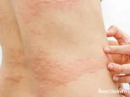 Ambalajlı Gıdalar Çocuklarda Ürtikere Sebep Oluyor!