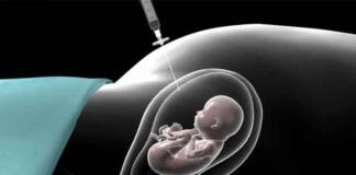 Amniyosentez; fetusun içinde yaşadığı amniyotik sıvıdan örnek alınarak incelenmesi işlemidir.