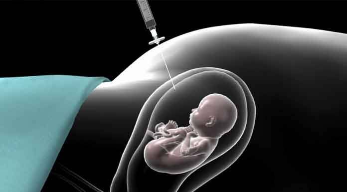 Amniyosentez; fetusun içinde yaşadığı amniyotik sıvıdan örnek alınarak incelenmesi işlemidir.