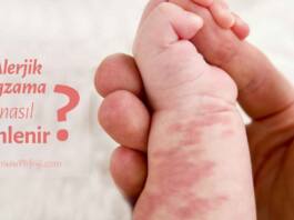 Alerjik egzama nasıl önlenir? egzama nasıl tedavi edilir